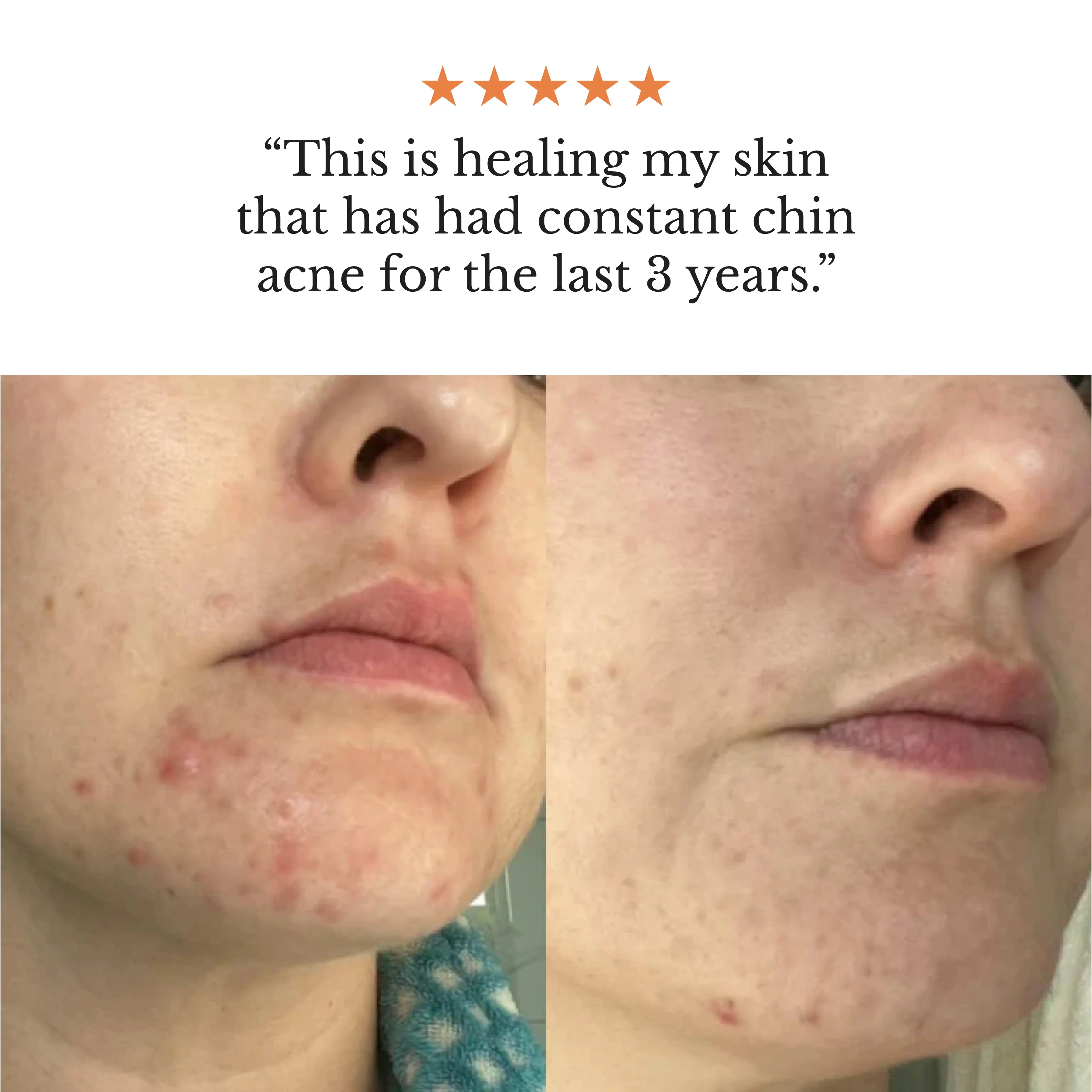 The Complete Acne System for Women - Image 5